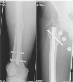 X-ray showing femoral nail and anchor screws