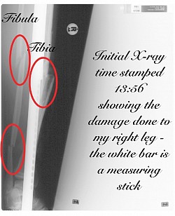 Compound fracture r lower leg